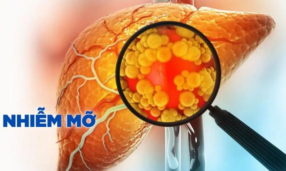 gan nhiễm mỡ, làm sao khỏi gan nhiễm mỡ, sức khỏe